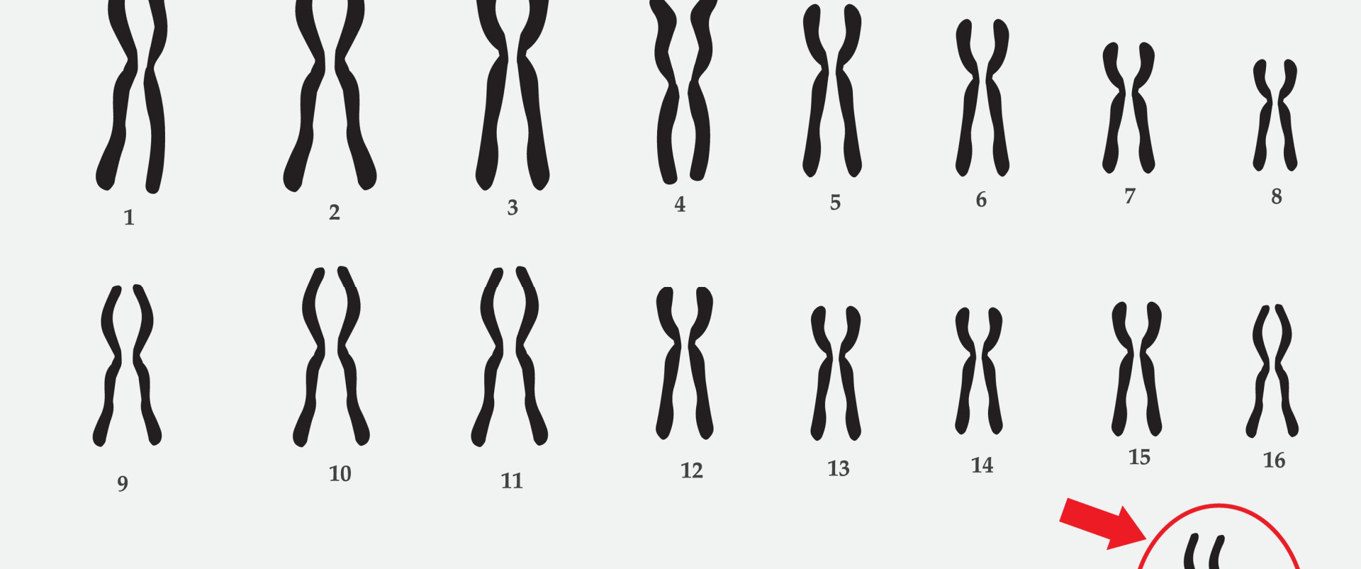 Klinefelter Syndrome of a Male - AndroNeo Hospital