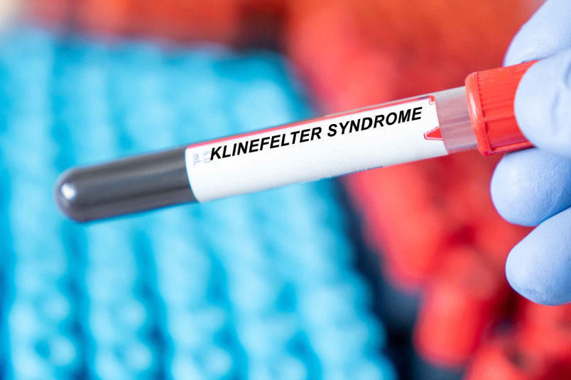 Klinefelter syndrome Blood Test - AndroNeo Hospitals