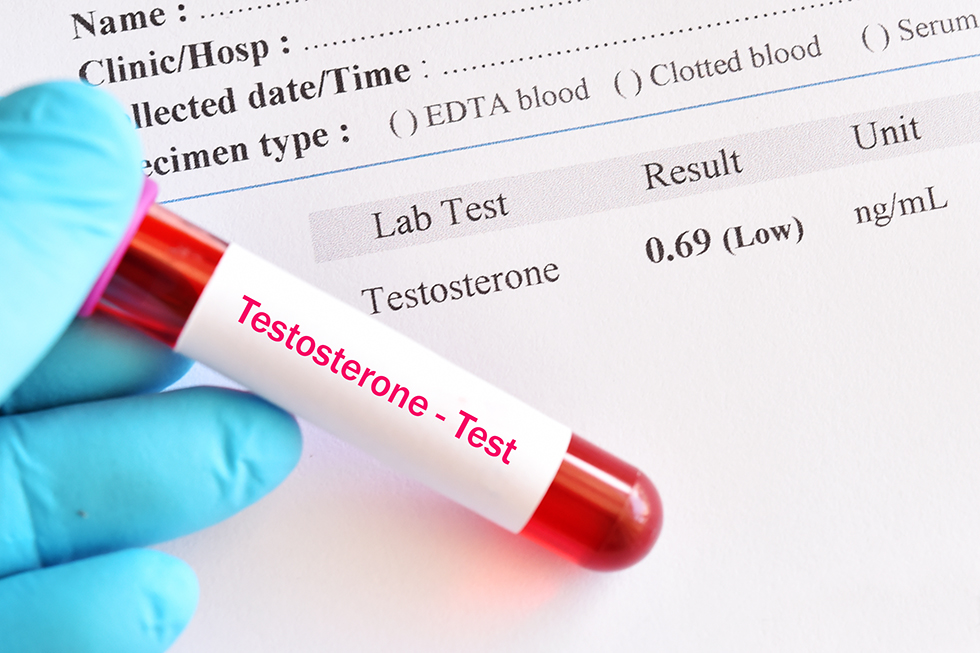 Testosterone Test - AndeoNeo Hospital 